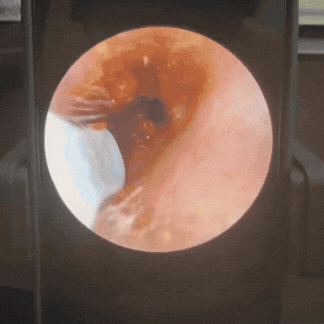 Zdrovia VisioEar – Dbaj o swoje uszy, nie narażając błony bębenkowej